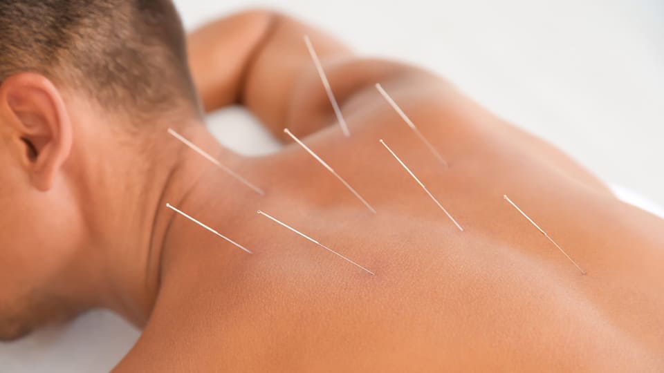 Кодирование иглоукалыванием